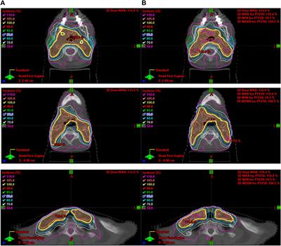 A reinforcement learning agent for head and neck intensity-modulated radiation therapy